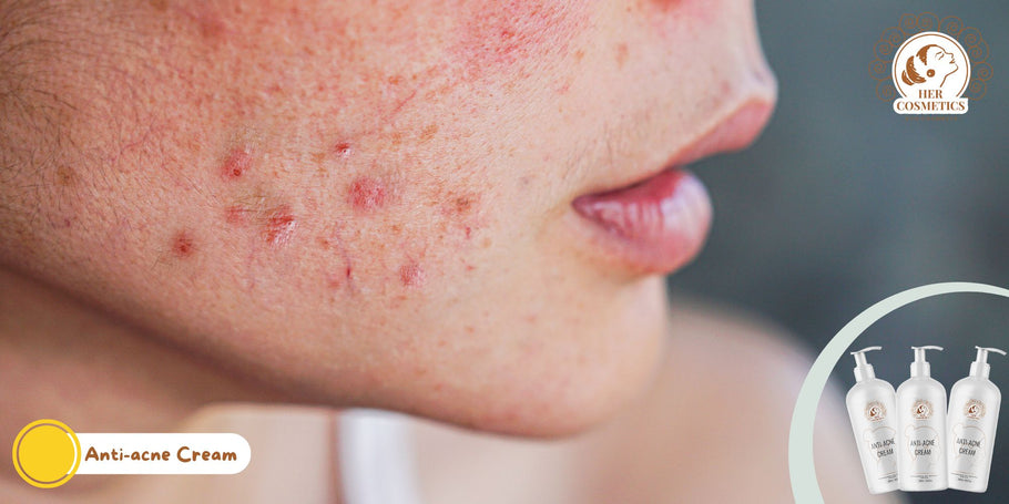 Como acabar com a acne facial?